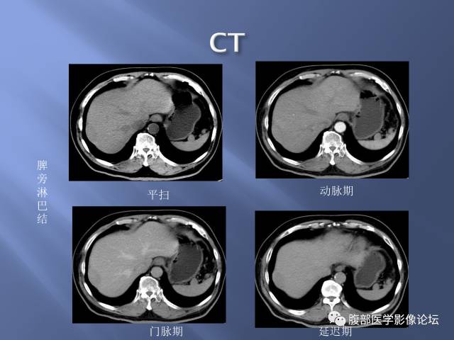 【病例】肝周恶性间皮瘤1例CT及MR影像表现 【病例】肝周恶性间皮瘤1例CT及MR影像表现