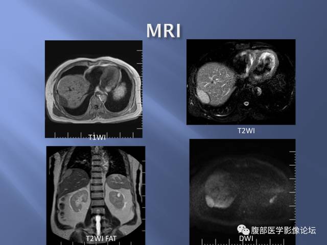 【病例】肝周恶性间皮瘤1例CT及MR影像表现 【病例】肝周恶性间皮瘤1例CT及MR影像表现
