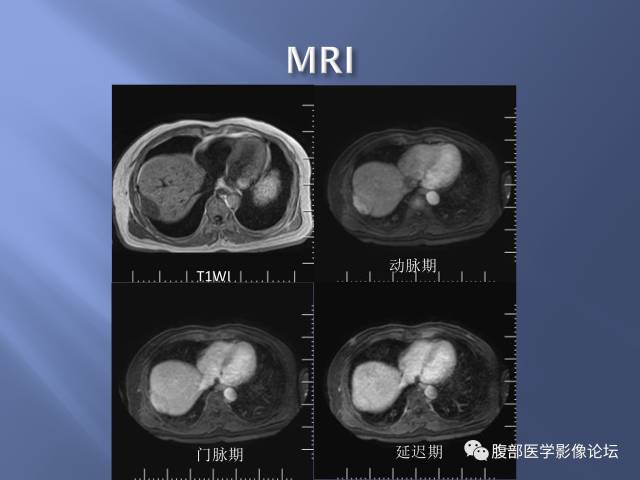 【病例】肝周恶性间皮瘤1例CT及MR影像表现 【病例】肝周恶性间皮瘤1例CT及MR影像表现