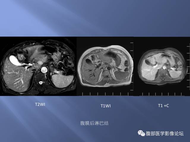 【病例】肝周恶性间皮瘤1例CT及MR影像表现 【病例】肝周恶性间皮瘤1例CT及MR影像表现