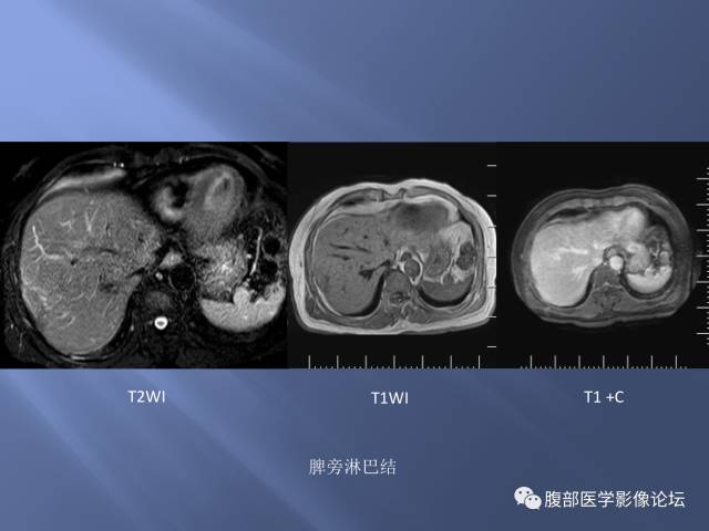 【病例】肝周恶性间皮瘤1例CT及MR影像表现 【病例】肝周恶性间皮瘤1例CT及MR影像表现