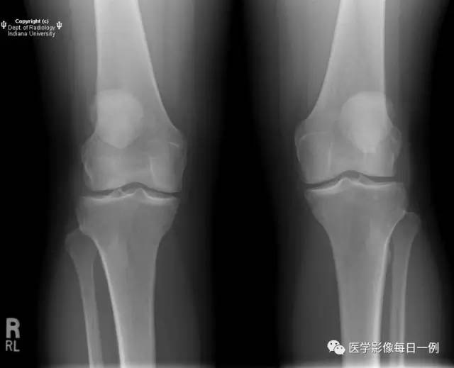 【病例】髌骨软化症1例X线及MR 【病例】髌骨软化症1例X线及MR