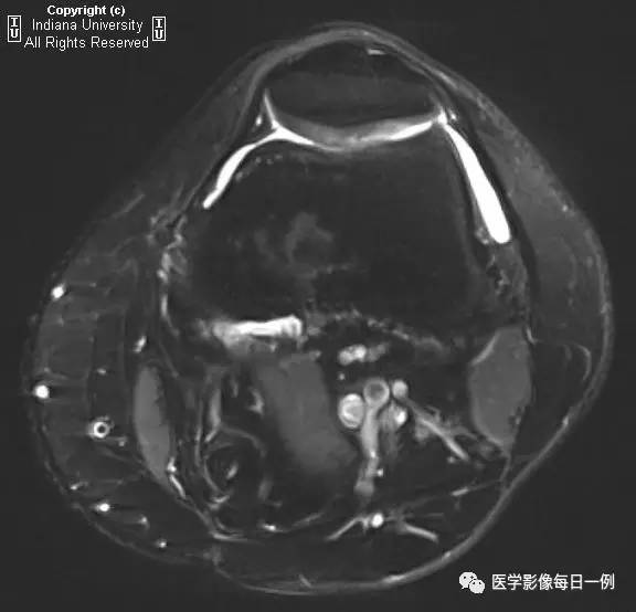 【病例】髌骨软化症1例X线及MR 【病例】髌骨软化症1例X线及MR