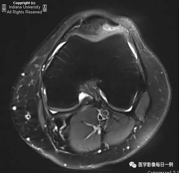 【病例】髌骨软化症1例X线及MR