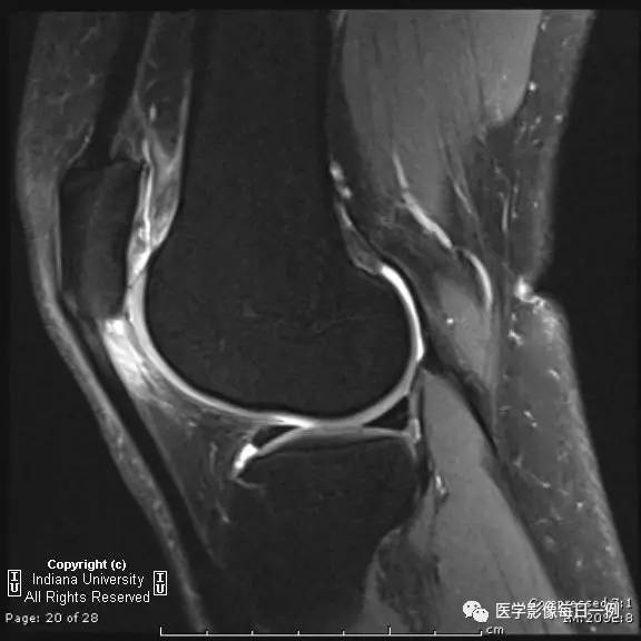 【病例】髌骨软化症1例X线及MR 【病例】髌骨软化症1例X线及MR