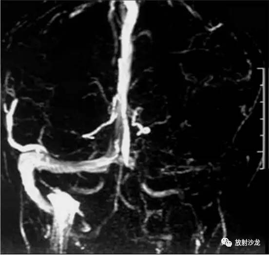 【病例】一侧静脉窦血栓1例CT及MR 【病例】一侧静脉窦血栓1例CT及MR