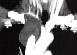 【病例】肺隔离症1例CT影像表现分析 【病例】肺隔离症1例CT影像表现分析