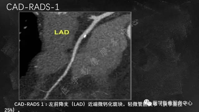 【PPT】CAD-RADS冠状动脉CTA模板