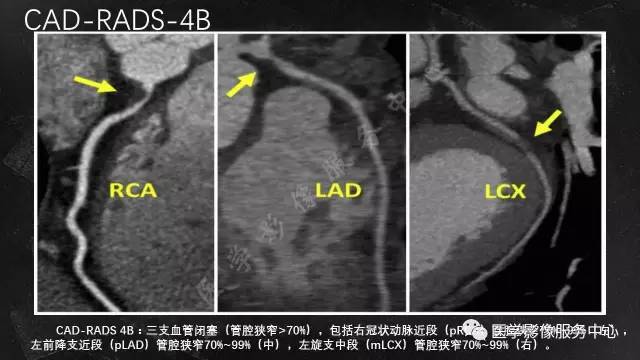【PPT】CAD-RADS冠状动脉CTA模板