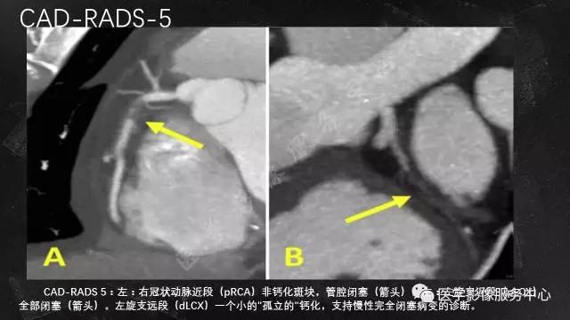 【PPT】CAD-RADS冠状动脉CTA模板