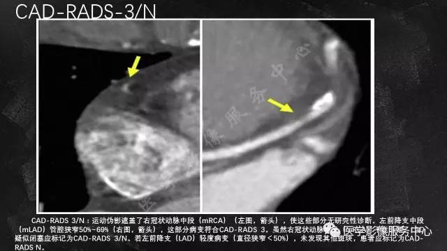【PPT】CAD-RADS冠状动脉CTA模板