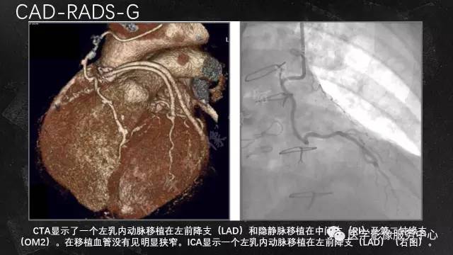 【PPT】CAD-RADS冠状动脉CTA模板