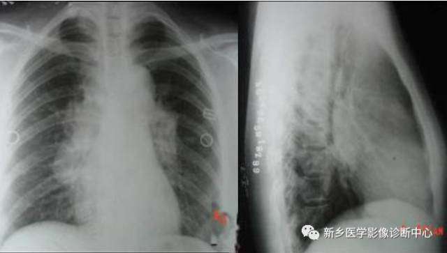 肺门增大应想到的6个疾病