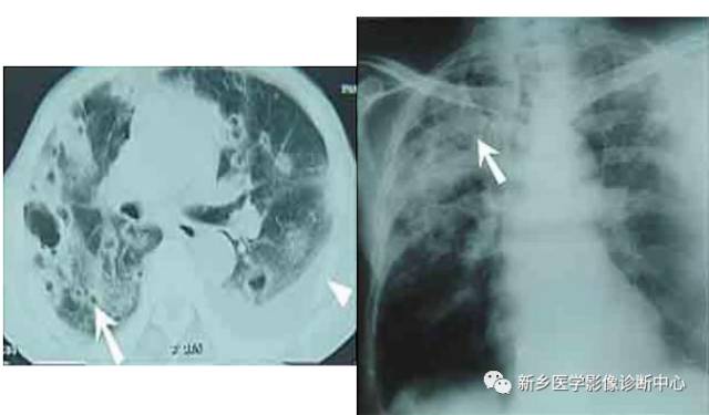 肺门增大应想到的6个疾病
