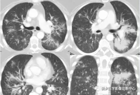 肺门增大应想到的6个疾病