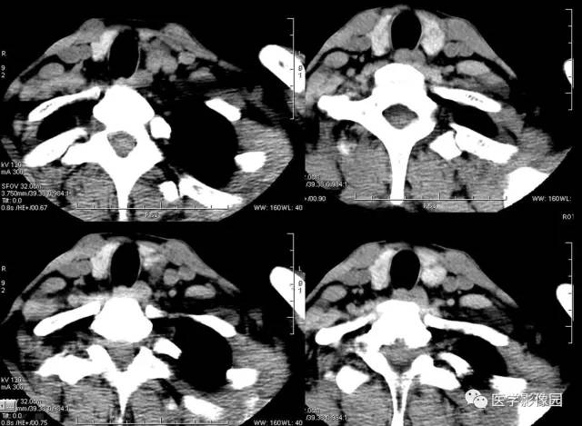 【病例】左甲状旁腺腺瘤1例CT影像表现 【病例】左甲状旁腺腺瘤1例CT影像表现