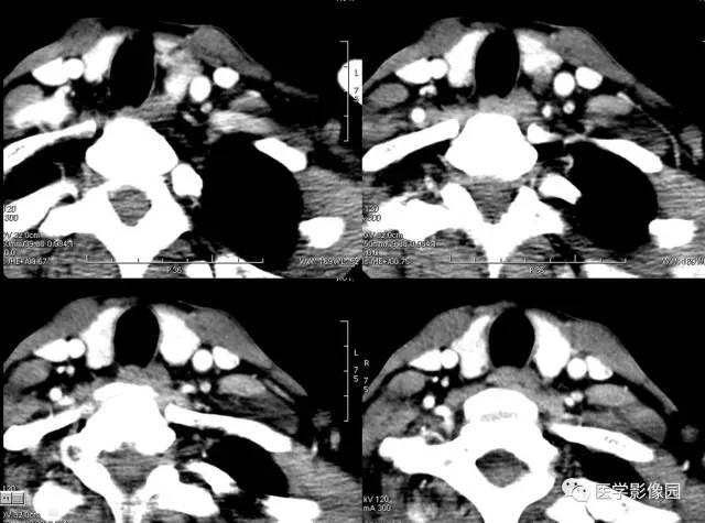 【病例】左甲状旁腺腺瘤1例CT影像表现 【病例】左甲状旁腺腺瘤1例CT影像表现