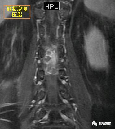 【病例对比读片】椎管内髓外硬膜下肿瘤4例，请您诊断！