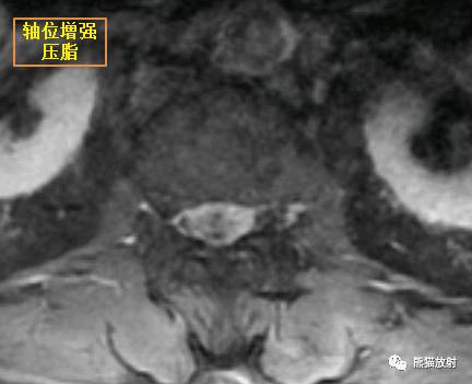 【病例对比读片】椎管内髓外硬膜下肿瘤4例，请您诊断！