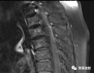 【病例对比读片】椎管内髓外硬膜下肿瘤4例，请您诊断！