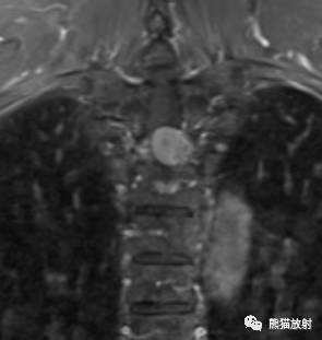 【病例对比读片】椎管内髓外硬膜下肿瘤4例，请您诊断！