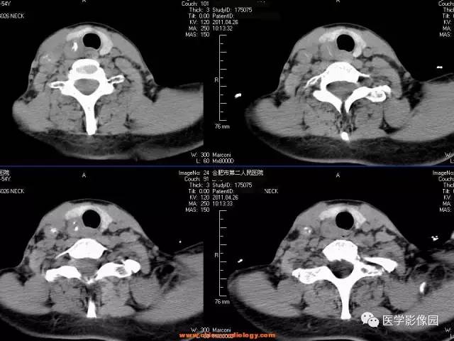 【病例】甲状腺乳头状癌伴颈部淋巴结转移1例CT影像表现 【病例】甲状腺乳头状癌伴颈部淋巴结转移1例CT影像表现