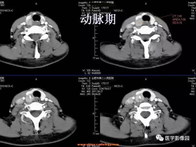 【病例】甲状腺乳头状癌伴颈部淋巴结转移1例CT影像表现 【病例】甲状腺乳头状癌伴颈部淋巴结转移1例CT影像表现