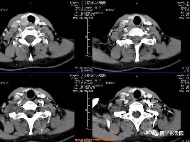 【病例】甲状腺乳头状癌伴颈部淋巴结转移1例CT影像表现 【病例】甲状腺乳头状癌伴颈部淋巴结转移1例CT影像表现