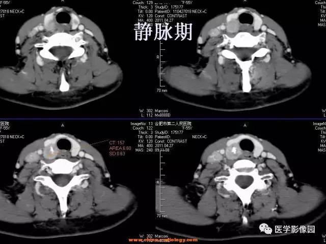 【病例】甲状腺乳头状癌伴颈部淋巴结转移1例CT影像表现 【病例】甲状腺乳头状癌伴颈部淋巴结转移1例CT影像表现