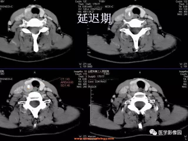 【病例】甲状腺乳头状癌伴颈部淋巴结转移1例CT影像表现 【病例】甲状腺乳头状癌伴颈部淋巴结转移1例CT影像表现