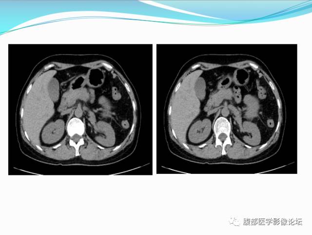 【病例】腹部骨外去分化软骨肉瘤1例CT影响表现 【病例】腹部骨外去分化软骨肉瘤1例CT影响表现