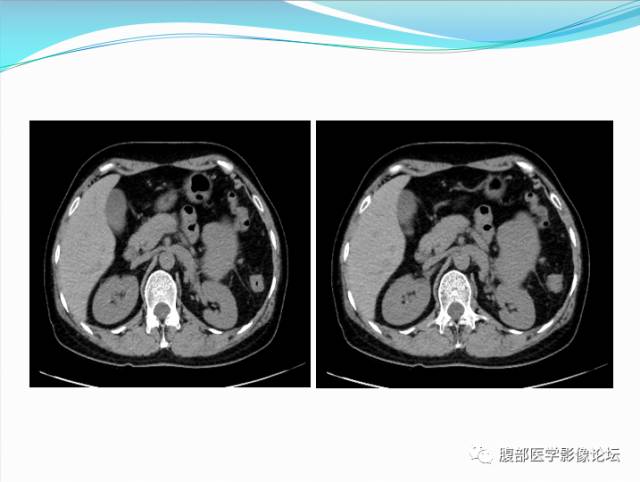【病例】腹部骨外去分化软骨肉瘤1例CT影响表现 【病例】腹部骨外去分化软骨肉瘤1例CT影响表现