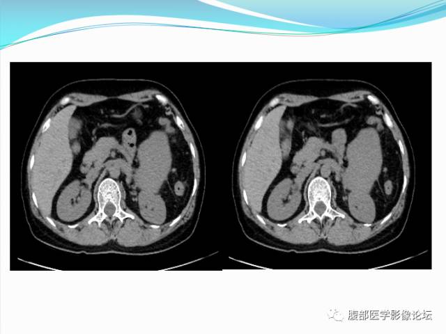【病例】腹部骨外去分化软骨肉瘤1例CT影响表现 【病例】腹部骨外去分化软骨肉瘤1例CT影响表现