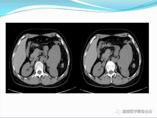 【病例】腹部骨外去分化软骨肉瘤1例CT影响表现 【病例】腹部骨外去分化软骨肉瘤1例CT影响表现