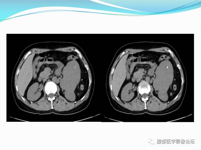 【病例】腹部骨外去分化软骨肉瘤1例CT影响表现 【病例】腹部骨外去分化软骨肉瘤1例CT影响表现
