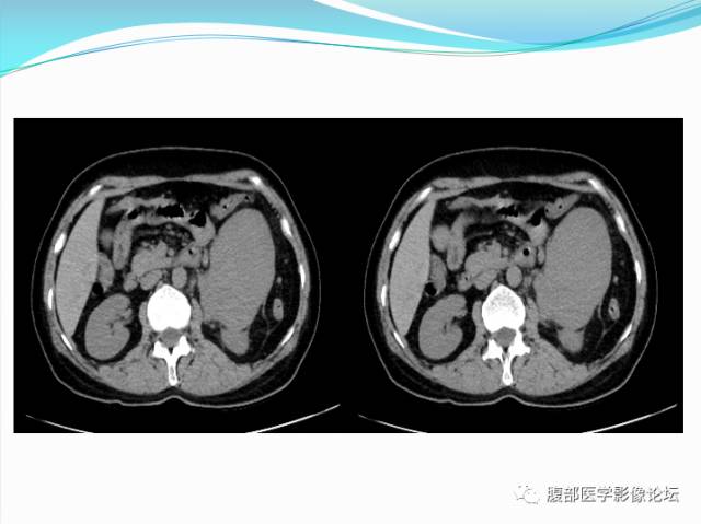 【病例】腹部骨外去分化软骨肉瘤1例CT影响表现 【病例】腹部骨外去分化软骨肉瘤1例CT影响表现