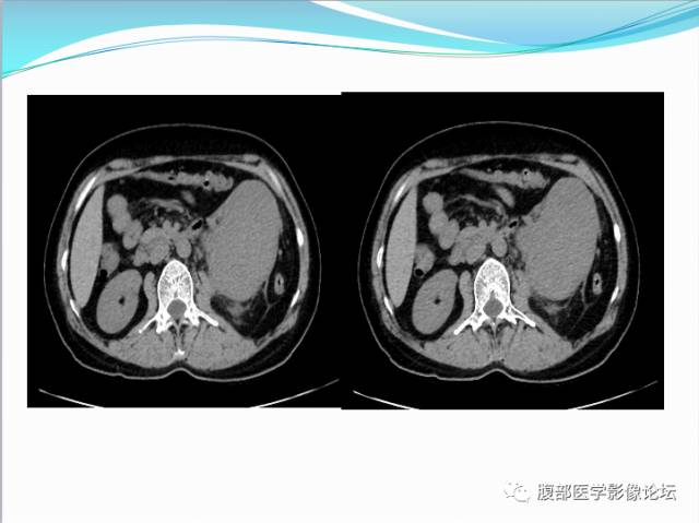【病例】腹部骨外去分化软骨肉瘤1例CT影响表现 【病例】腹部骨外去分化软骨肉瘤1例CT影响表现