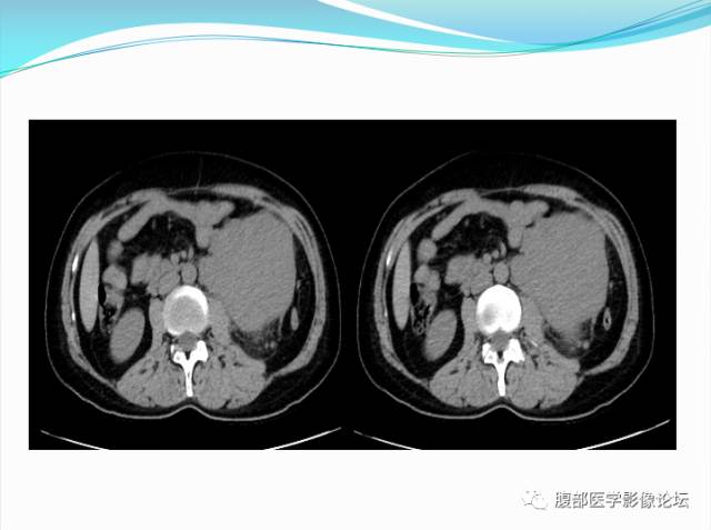 【病例】腹部骨外去分化软骨肉瘤1例CT影响表现 【病例】腹部骨外去分化软骨肉瘤1例CT影响表现