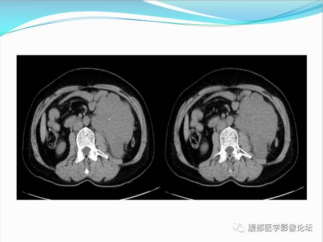 【病例】腹部骨外去分化软骨肉瘤1例CT影响表现 【病例】腹部骨外去分化软骨肉瘤1例CT影响表现
