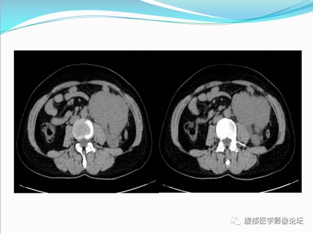 【病例】腹部骨外去分化软骨肉瘤1例CT影响表现 【病例】腹部骨外去分化软骨肉瘤1例CT影响表现
