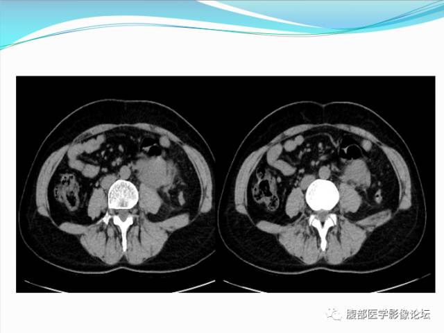 【病例】腹部骨外去分化软骨肉瘤1例CT影响表现 【病例】腹部骨外去分化软骨肉瘤1例CT影响表现