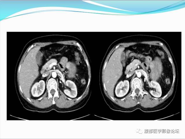 【病例】腹部骨外去分化软骨肉瘤1例CT影响表现 【病例】腹部骨外去分化软骨肉瘤1例CT影响表现