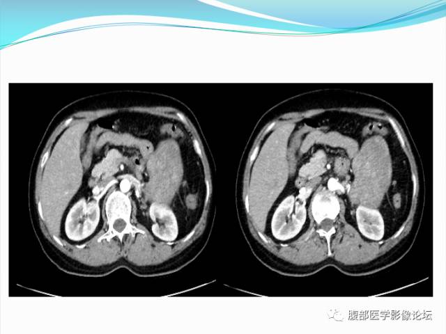 【病例】腹部骨外去分化软骨肉瘤1例CT影响表现 【病例】腹部骨外去分化软骨肉瘤1例CT影响表现