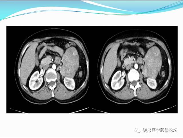 【病例】腹部骨外去分化软骨肉瘤1例CT影响表现 【病例】腹部骨外去分化软骨肉瘤1例CT影响表现