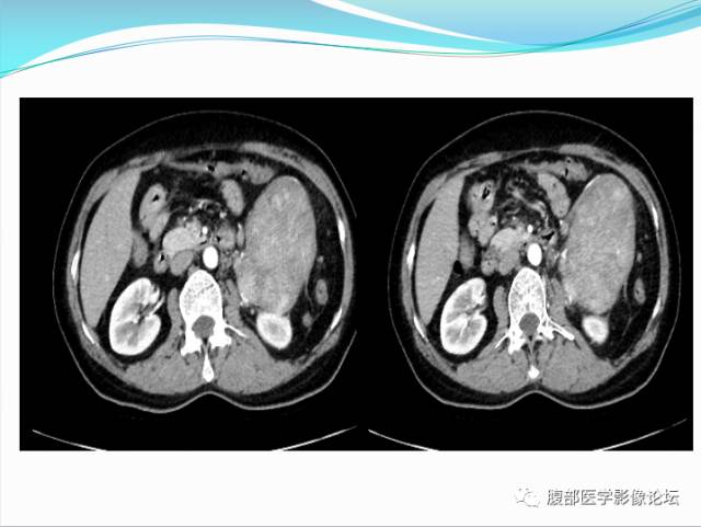 【病例】腹部骨外去分化软骨肉瘤1例CT影响表现 【病例】腹部骨外去分化软骨肉瘤1例CT影响表现