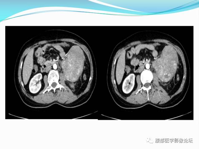 【病例】腹部骨外去分化软骨肉瘤1例CT影响表现 【病例】腹部骨外去分化软骨肉瘤1例CT影响表现