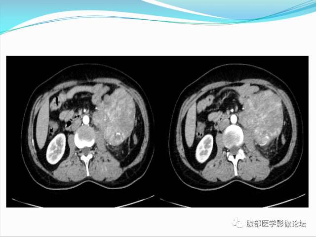 【病例】腹部骨外去分化软骨肉瘤1例CT影响表现 【病例】腹部骨外去分化软骨肉瘤1例CT影响表现