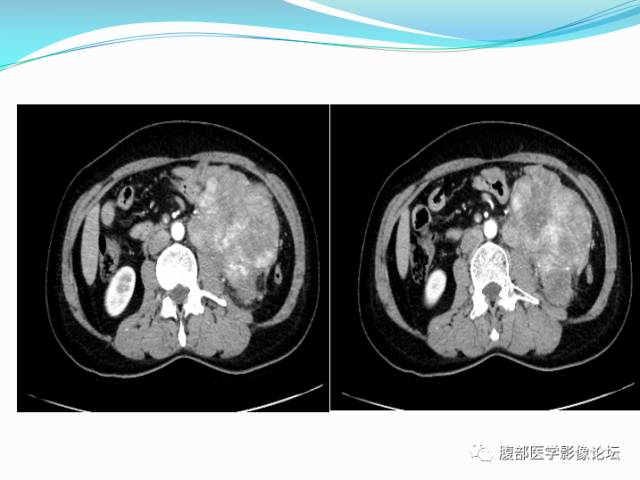 【病例】腹部骨外去分化软骨肉瘤1例CT影响表现 【病例】腹部骨外去分化软骨肉瘤1例CT影响表现