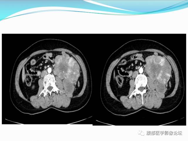 【病例】腹部骨外去分化软骨肉瘤1例CT影响表现 【病例】腹部骨外去分化软骨肉瘤1例CT影响表现