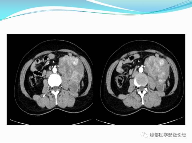 【病例】腹部骨外去分化软骨肉瘤1例CT影响表现 【病例】腹部骨外去分化软骨肉瘤1例CT影响表现
